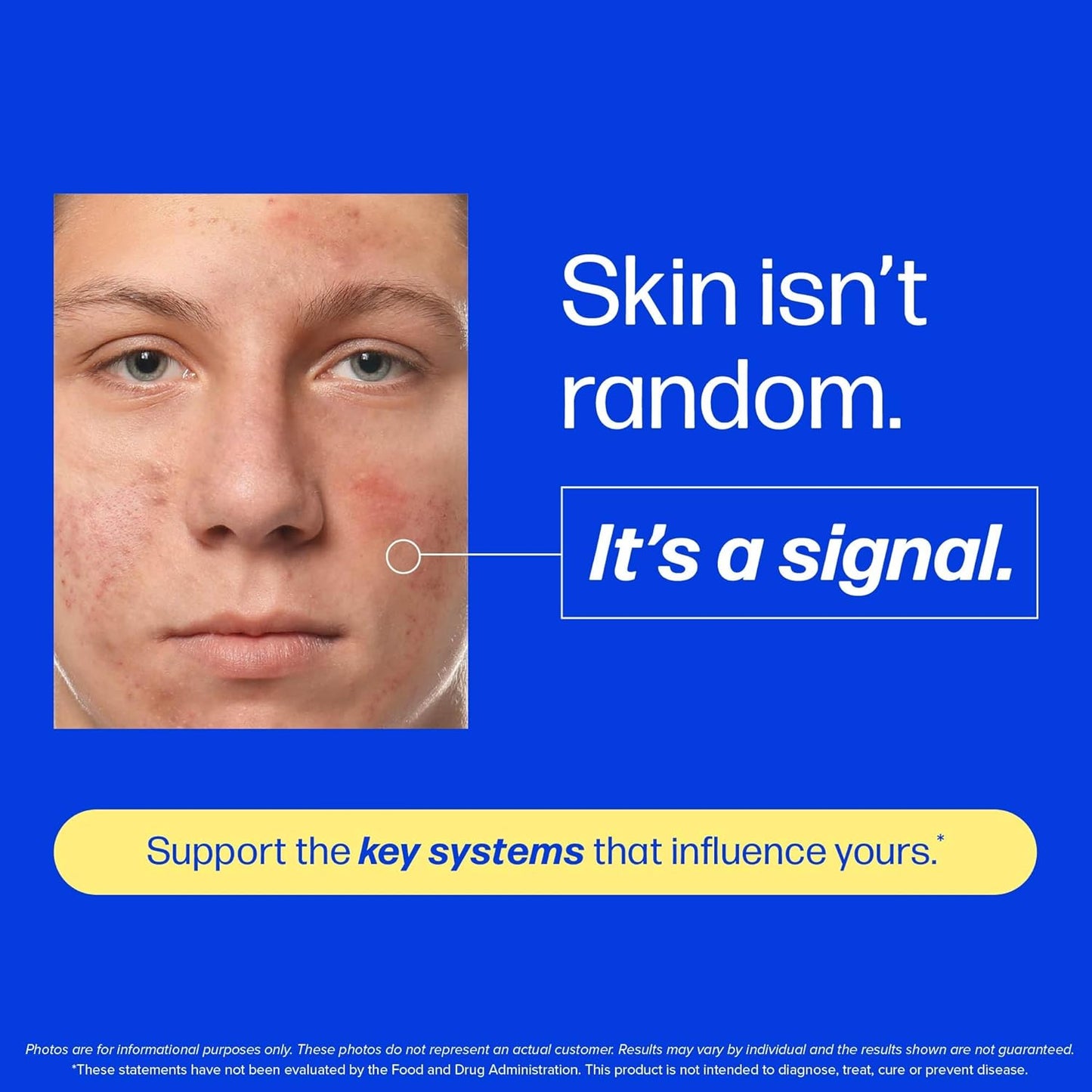3-in-1 Triple Action Acne Complex: Clear Your Skin from Within